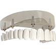 implant