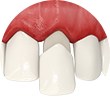 implant