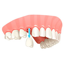 extraction of teeth